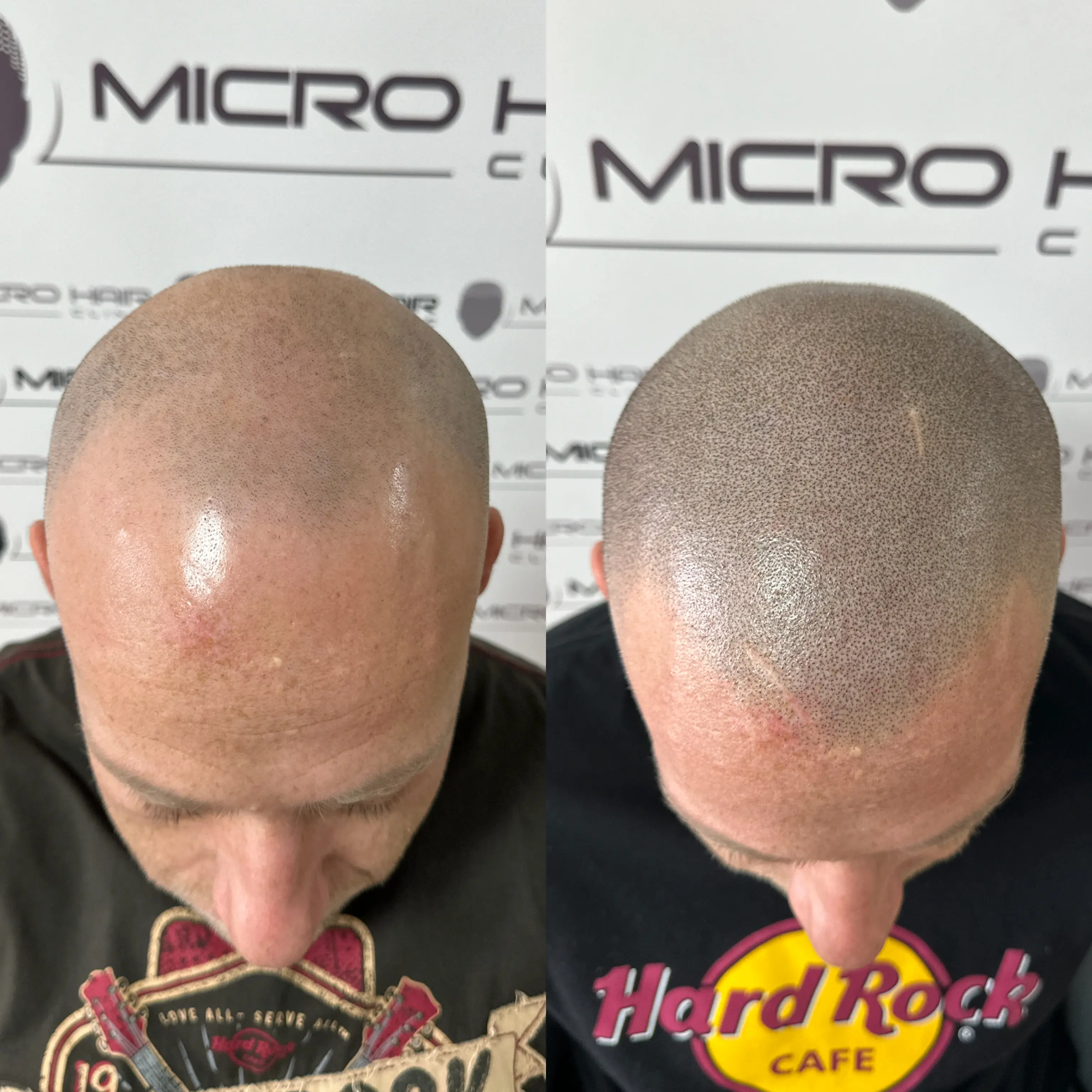 SMP tretman - fotografija iz galerije Micro Hair Clinic