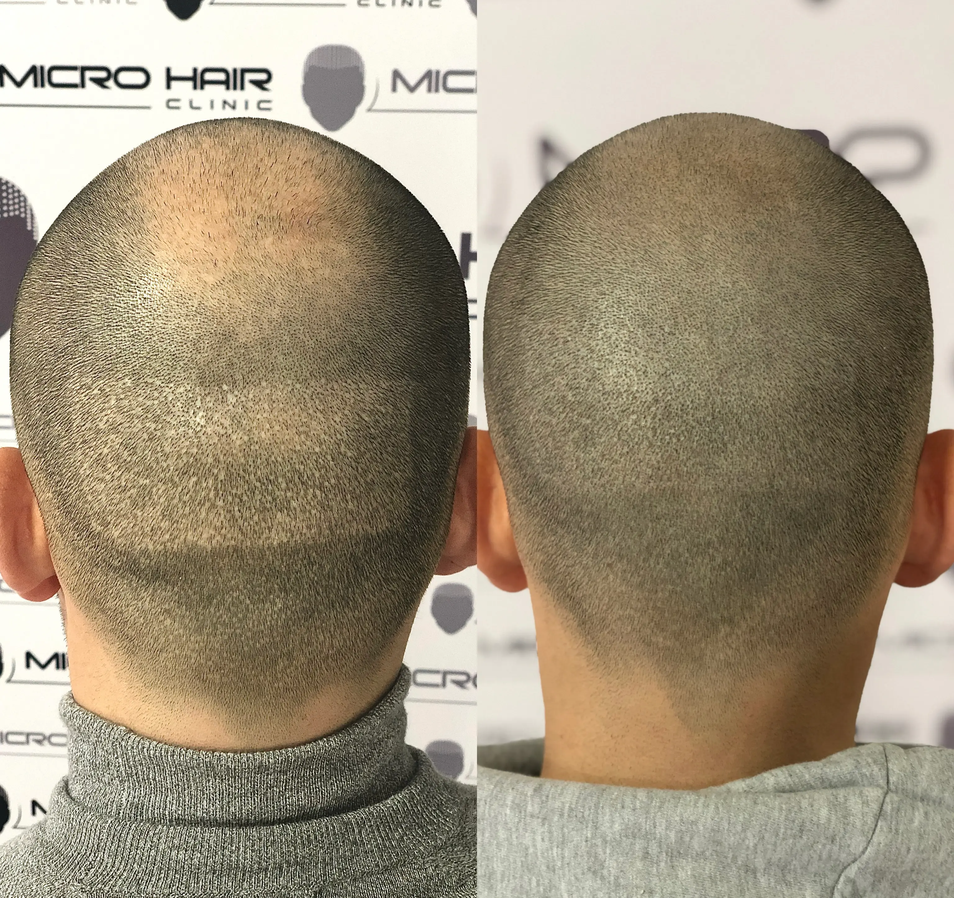 SMP tretman - fotografija iz galerije Micro Hair Clinic