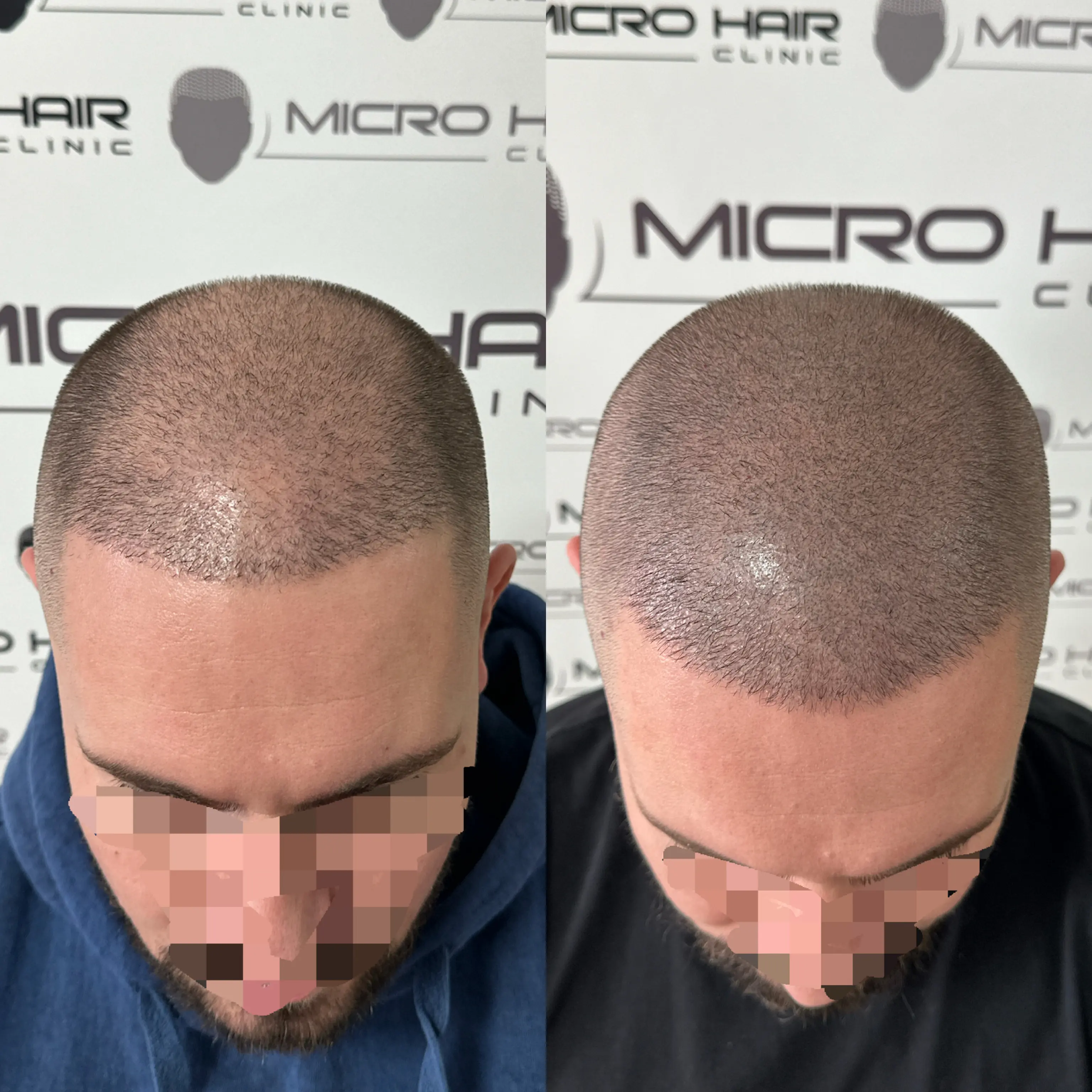 SMP tretman - fotografija iz galerije Micro Hair Clinic